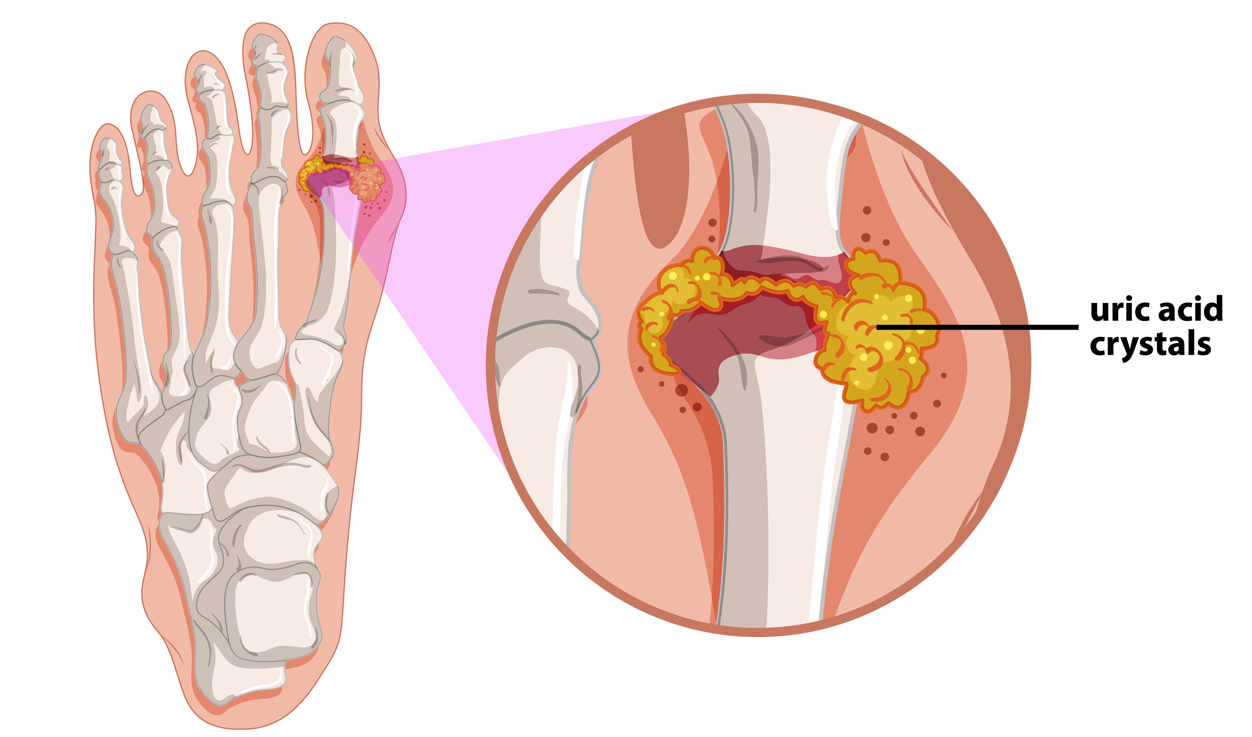 Inhibitors of Guanine Deaminase for Hyperuricemia and <b>Gout</b>.