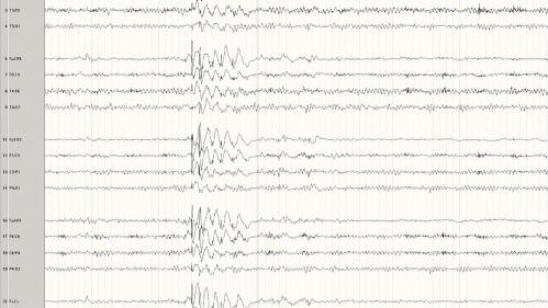 A representative EEG of a patient with generalized Epilepsy.