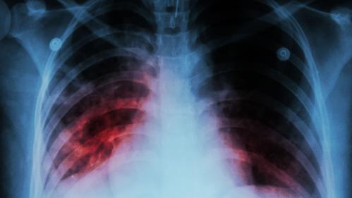 Tuberculosis