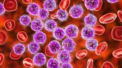 leukemia Adobe Stock