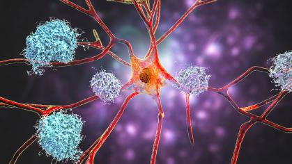 Neurons in Alzheimer's disease. Illustration showing amyloid plaques in brain tissue