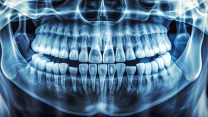 X-ray image of a human jawbone showing significant bone loss