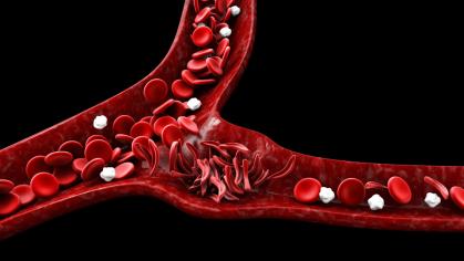 Sickle Cell