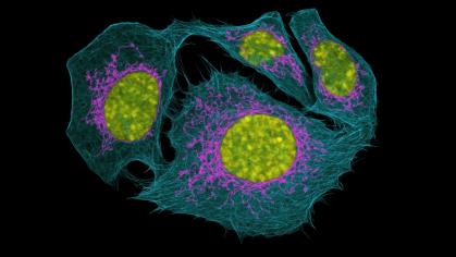 Confocal microscopy image of prostate cancer cells, showing multiple rounded cell bodies with visible nuclei in yellow, surrounded by bright pink mitochondria and blue filamentous cytoskeleton