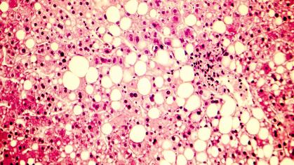 Fatty Liver