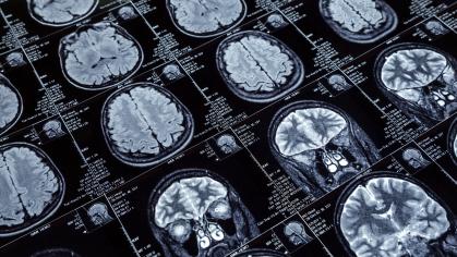 MRI images of human brains