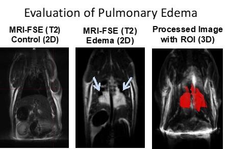 pulmonary edema evaluation
