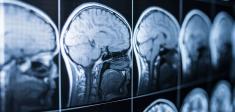 Image of brain scans